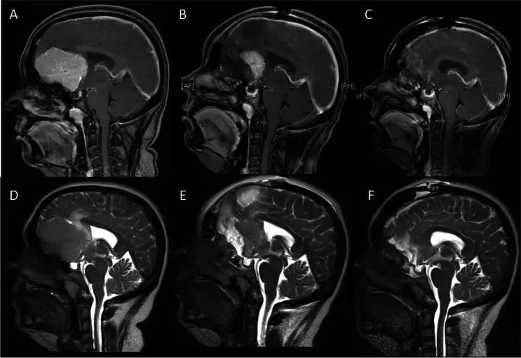 图1：矢状位磁共振成像。增强T1加权（A-C）与T2加权（D-F）图像显示瘤周水肿情况。A、D：术前图像。B、E：首次术后第一天，显示残留的壳状肿瘤。C、F：第二次术后第一天，显示肿瘤已完全切除。