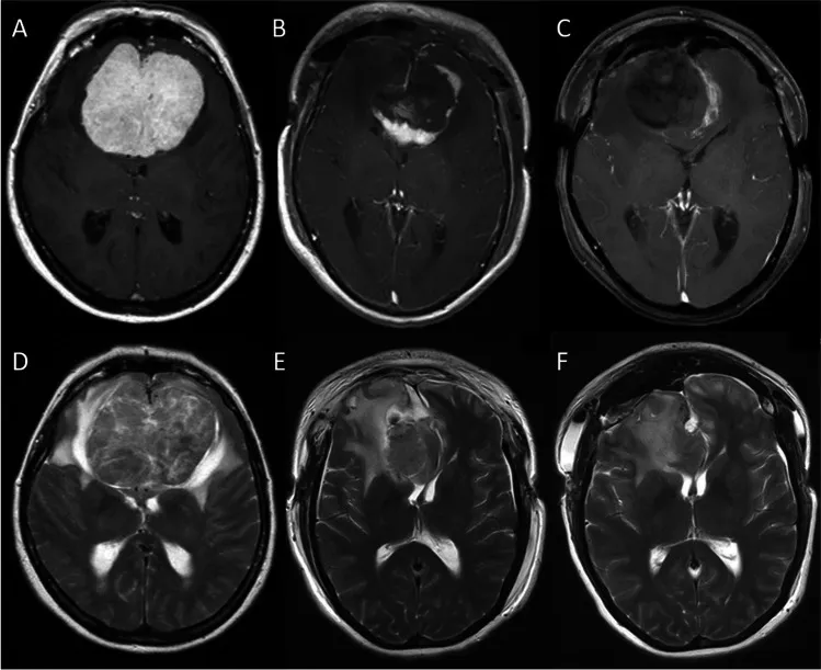 图2：冠状位磁共振成像。 增强T1加权（A-C）与T2加权（D-F）图像。A、D：术前图像。B、E：首次术后第一天，显示残留的壳状肿瘤。C、F：第二次术后第一天，显示肿瘤已完全切除。