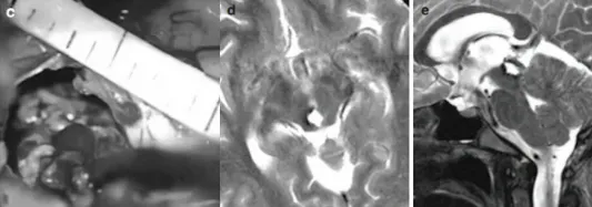 发现病变为典型的海绵状血管瘤，且伴有新鲜的病灶内出血。