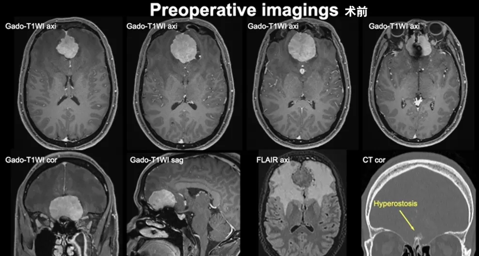 磁共振成像显示一直径43毫米的嗅沟脑膜瘤，伴有显著的双侧额叶瘤周水肿。