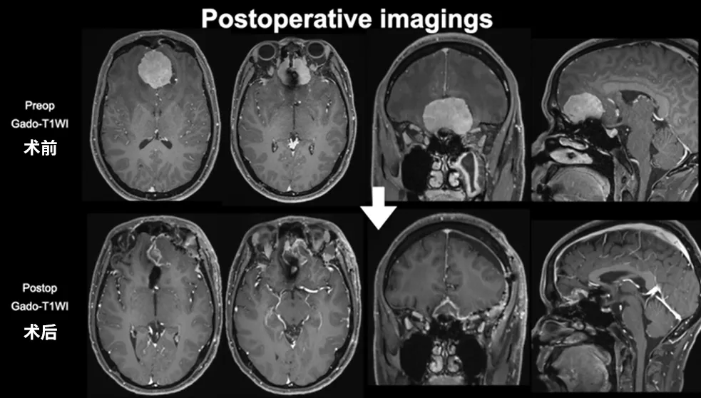 Postoperative imagings