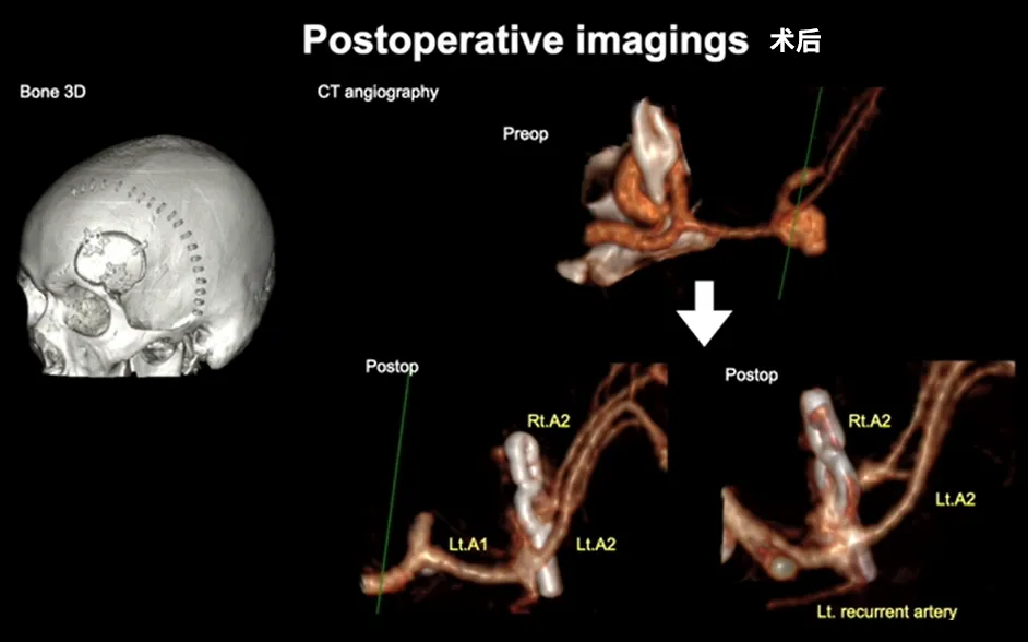 Postoperative imagings术后