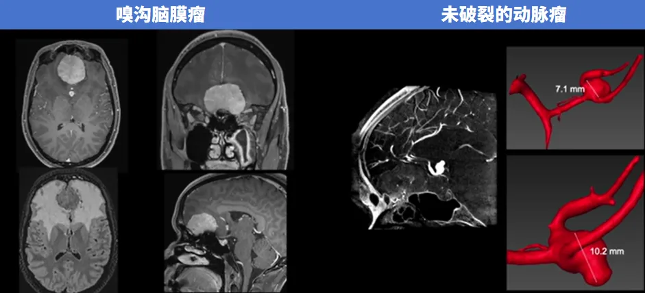 嗅沟脑膜瘤、未破裂的动脉瘤