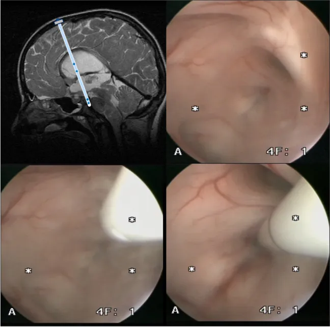 [支架辅助ETV技术操作细节