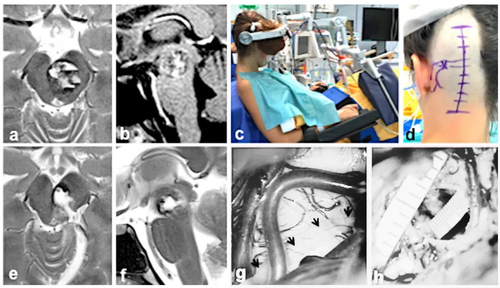 19岁女性，两次出血后神经功能受损