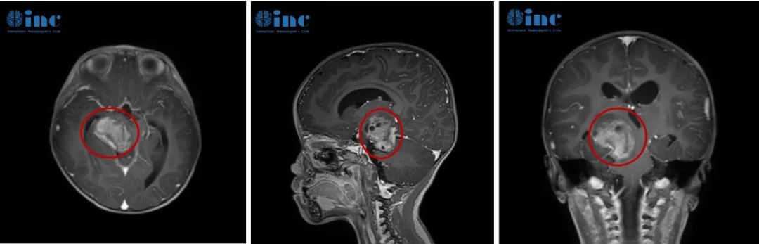 脑瘤患儿不能轻易开第二刀，是真的吗？