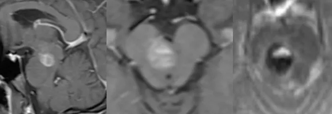 脑干海绵状血管瘤急性出血