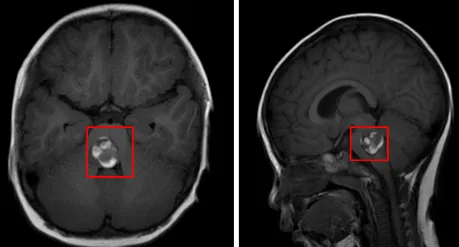 第四脑室底部占位性病变，考虑室管膜瘤可能。影像学特征提示肿瘤与脑干关系密切，存在潜在手术风险。
