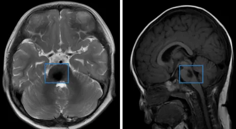 肿瘤全切了，一切顺利。