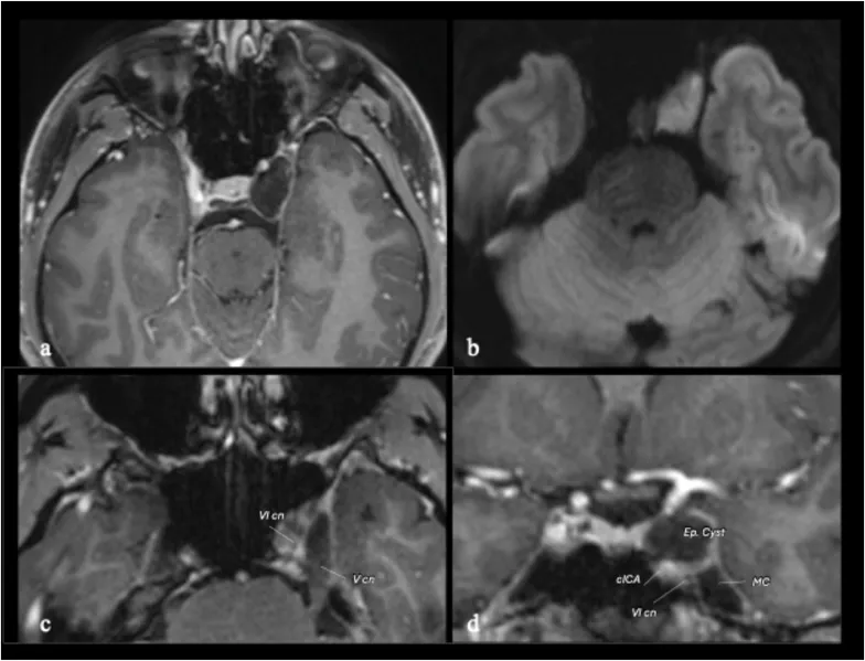 复查磁共振显示病变进行性增大