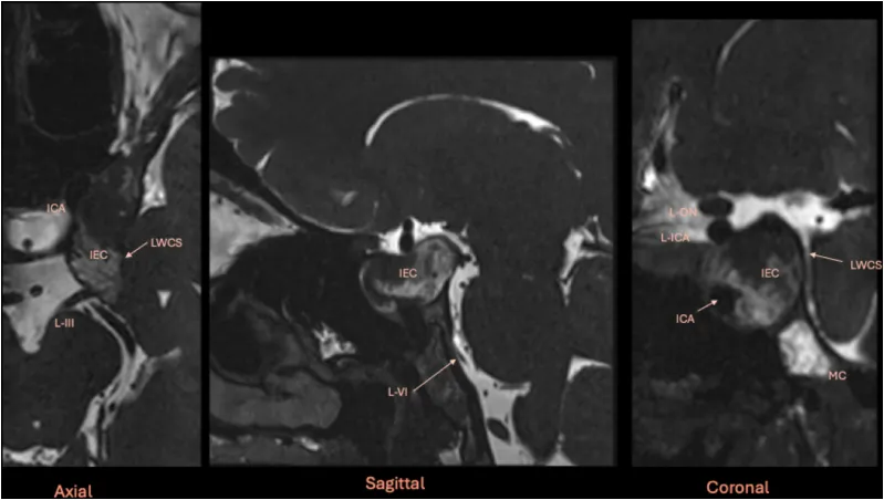 术前多平面磁共振成像CISS序列研究。