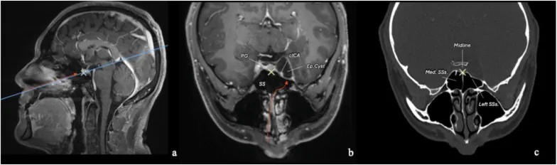 对侧单鼻孔内镜经鼻入路的术前影像规划。