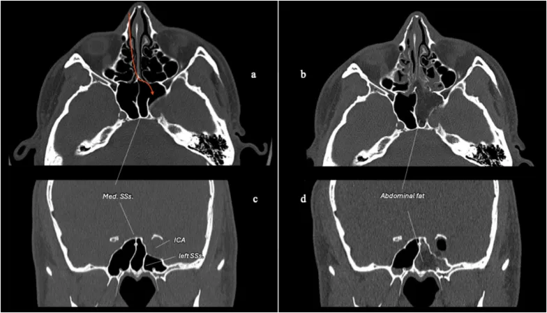 精准磨除左侧鼻甲前部部分骨质，显露并进入左侧蝶窦