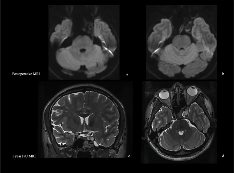 术后磁共振显示，海绵窦外侧壁上后内侧部分的囊肿已完全移除