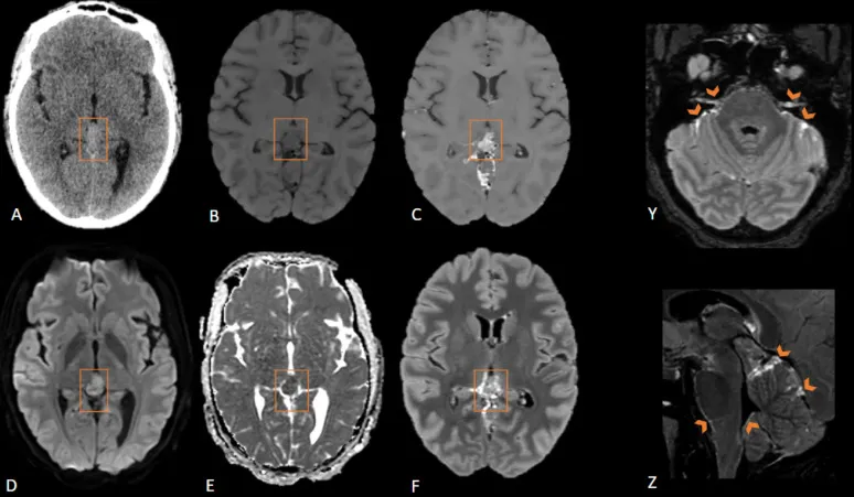 脑脊液hCG升高不是生殖细胞瘤？一个极易混淆的松果体母细胞瘤