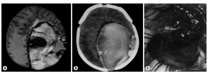 此例1天大的新生儿，在出生前几日经产前超声诊断为广泛的左侧顶枕叶出血。