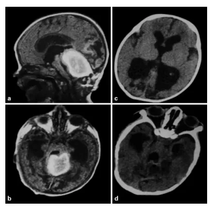 a, b. 一名25天大的婴儿的矢状位及轴位磁共振T1加权像。