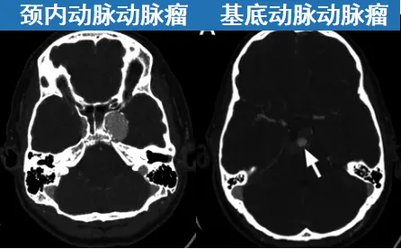 动脉瘤影像学表现及手术规划
