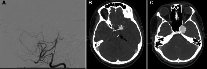 3个月复查影像显示，BTA完全闭塞并血栓形成，至左侧PCA区域的颅外-颅内（EC-IC）旁路通畅。