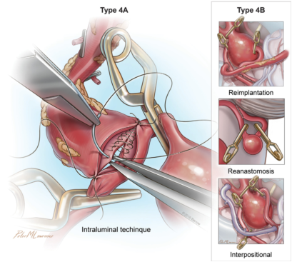 治疗方法  重在防止破裂出血