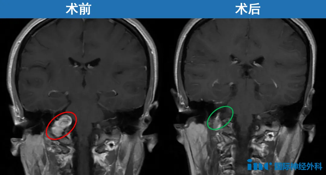 术前影像  术后影像