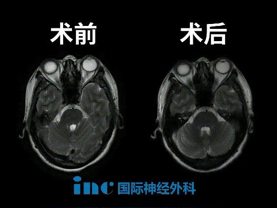本病例中，巴教授术中填塞了脂肪组织