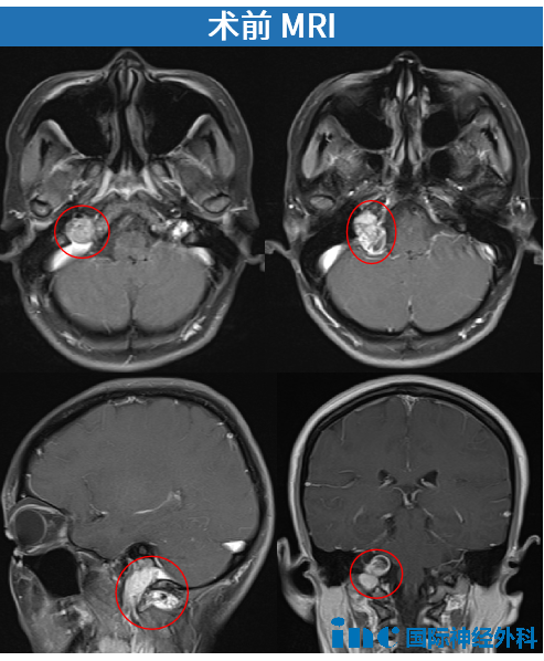 颈静脉孔区肿瘤