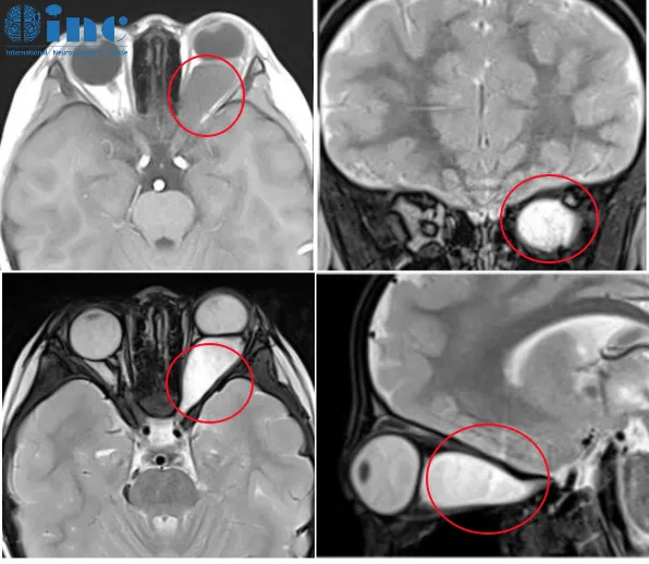 胶质瘤治疗选择决定预后？3岁儿童先化疗or先手术，INC两大国际神外大咖给出关