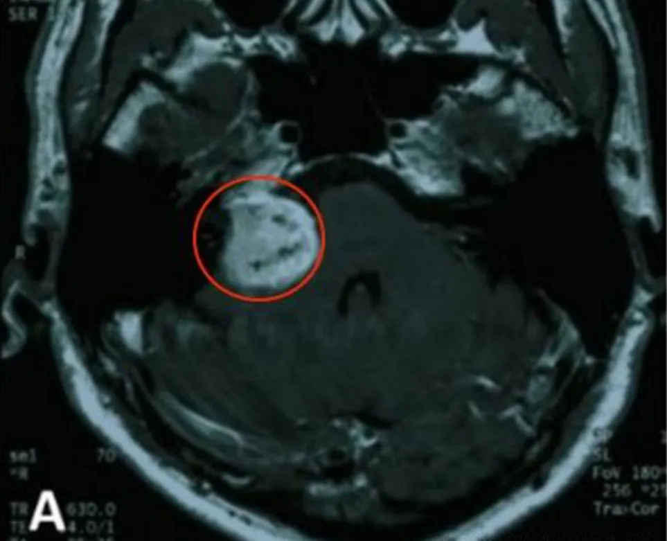 听神经瘤反复手术、放疗，10年后肿瘤为何依然恶变？