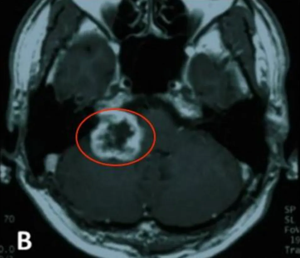 为控制残留肿瘤生长，患者接受伽玛刀放射外科治疗，边缘剂量10 Gy（50%等剂量线）