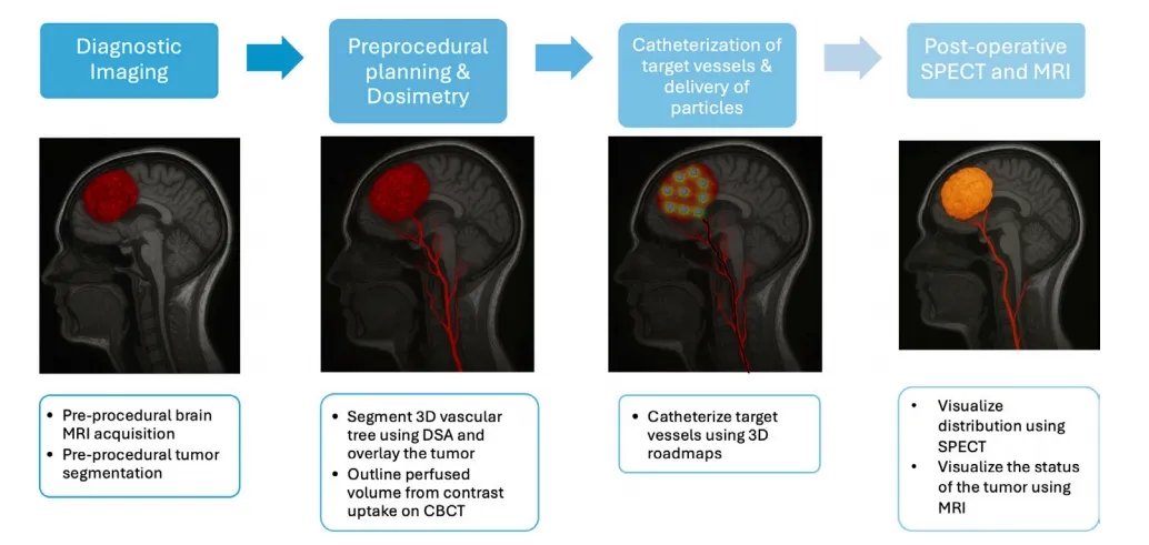 虽然使用 ⁹⁰Y 微球的动脉内放射栓塞在 HCC 中已确立，但其在神经肿瘤学中的应用在很大程度上仍处于理论和临床前阶段