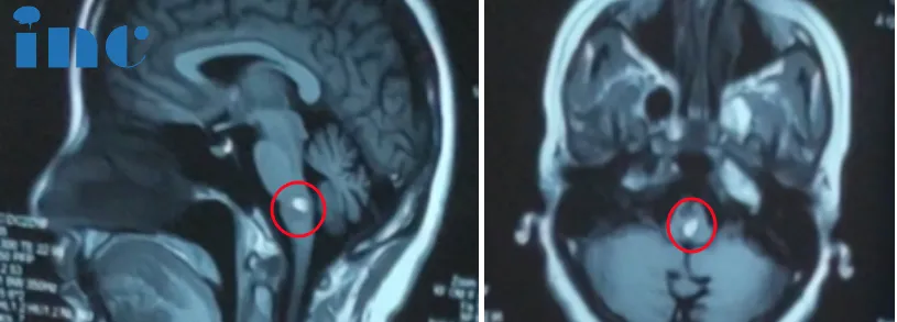 右手也出现了麻木的症状，核磁显示再次出血。