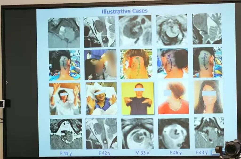 巴教授延髓海绵状血管瘤案例