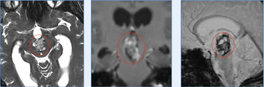Luna的颅脑MR显示中脑巨大占位，混杂信号，海绵状血管瘤可能。 