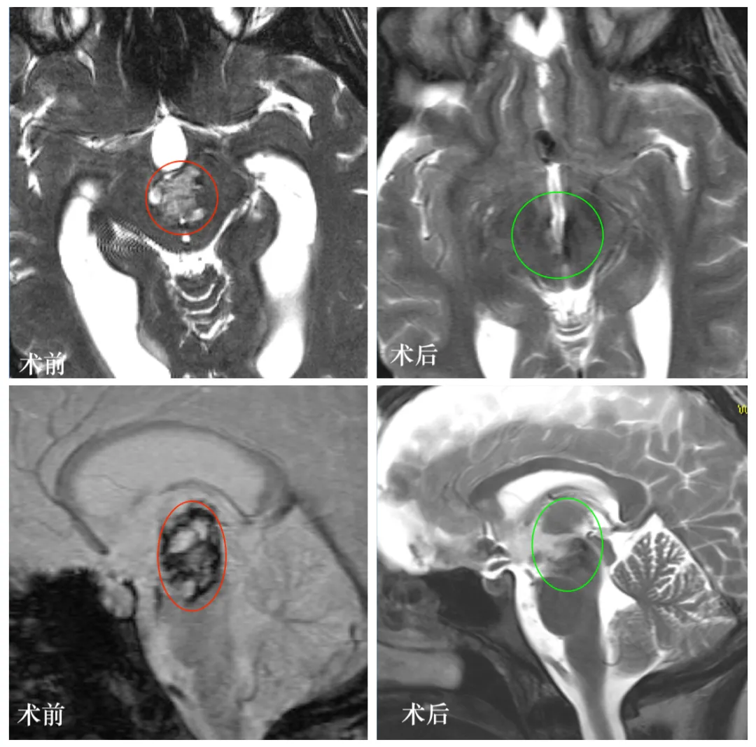 术前术后MRI对比