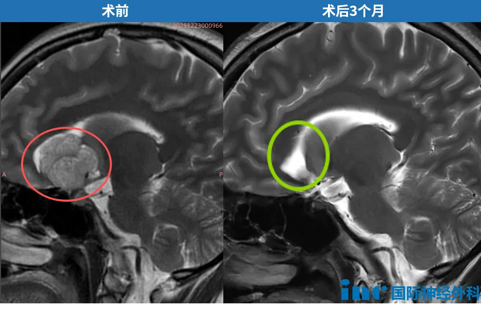 肿瘤全切除，无残留病灶，激素水平维持稳定