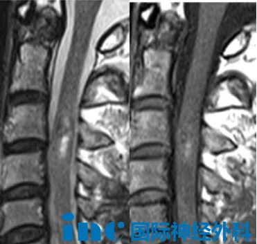 当前病灶尚处可干预阶段，手术时机选择适当，术后功能恢复的预后预期良好。