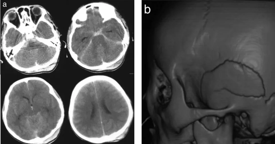 8岁男孩车祸后昏迷不醒，竟是更凶险的“颅内危机”正在发酵