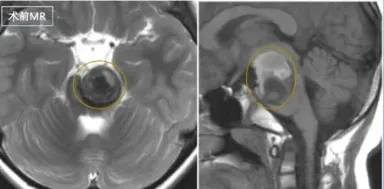 孩子力气变小却没重视，不知道他正经历“反复脑干出血”