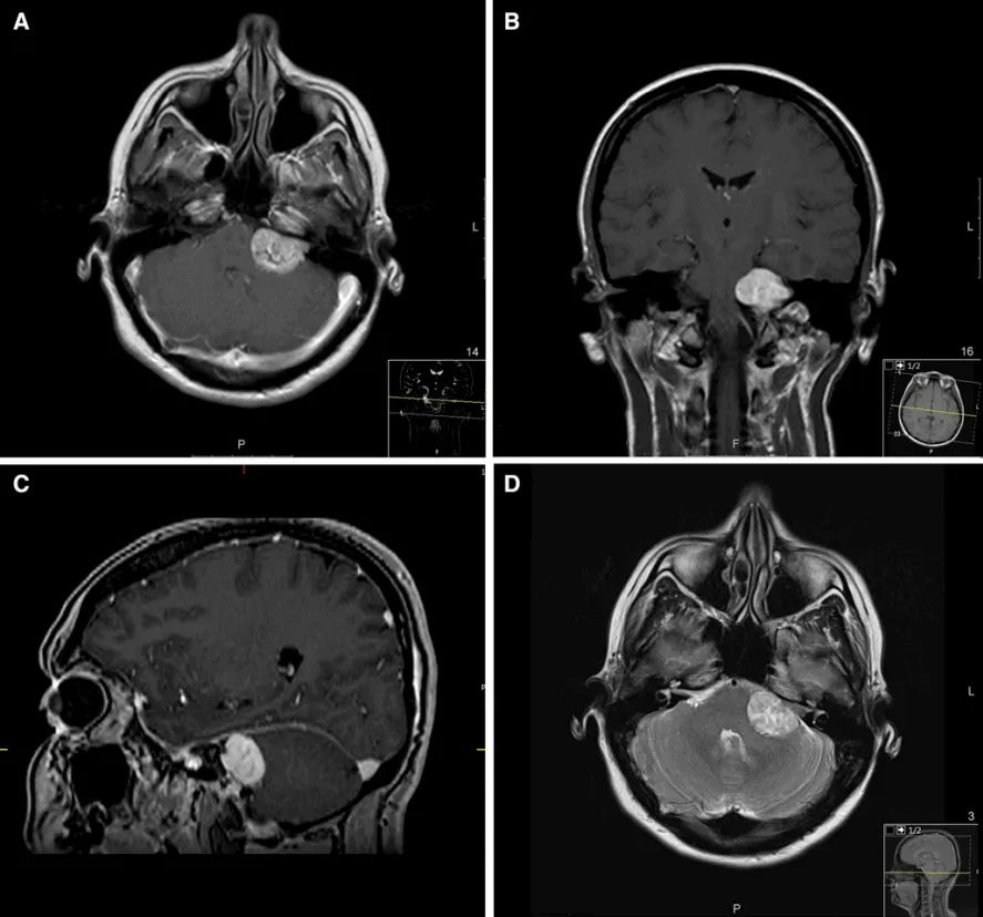 左侧桥小脑角区存在31×27×23mm 听神经瘤