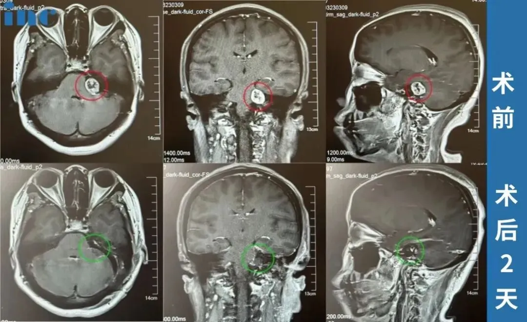 术后夜间头痛逐渐减轻，六个月后完全消失。