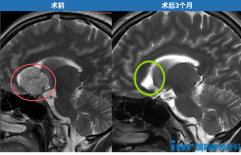 术前术后MRI对比