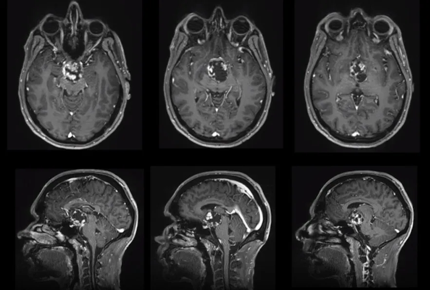 MRI影像进一步证实颅咽管瘤诊断，肿瘤已累及第三脑室及视神经通路，脑脊液循环通路受压，视觉功能损害持续进展，解剖毗邻关系高度复杂。