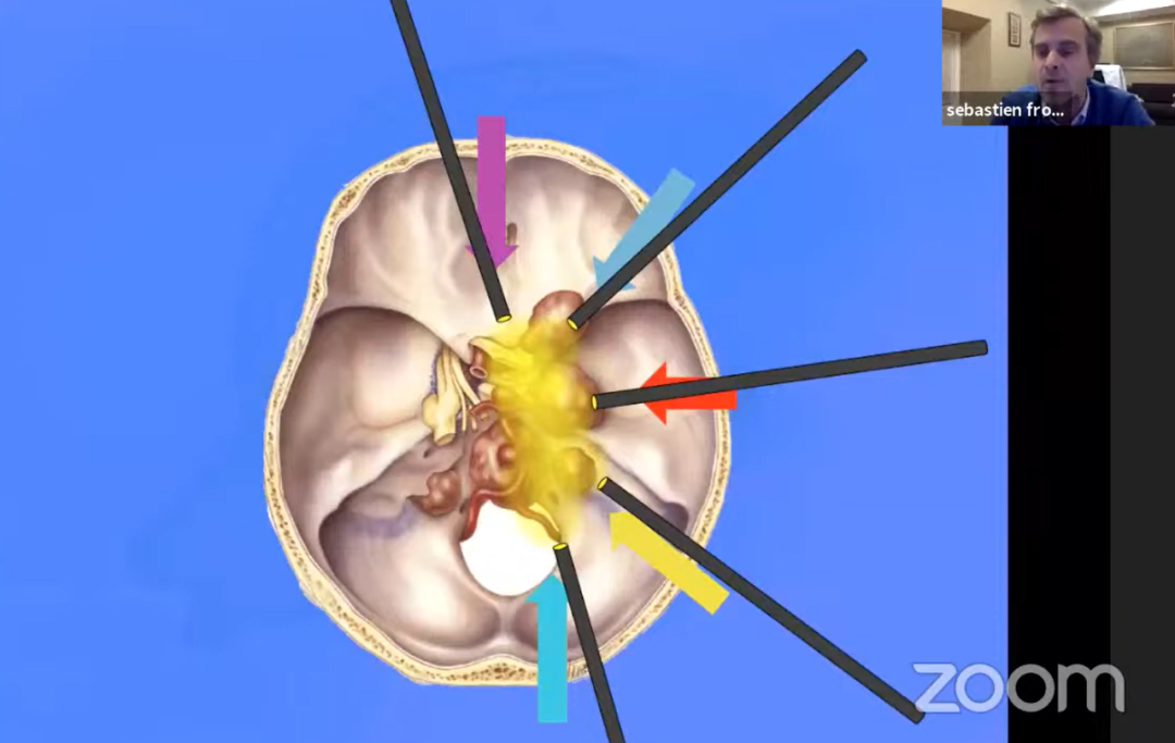 演讲中教授演示不同入路进入颅底