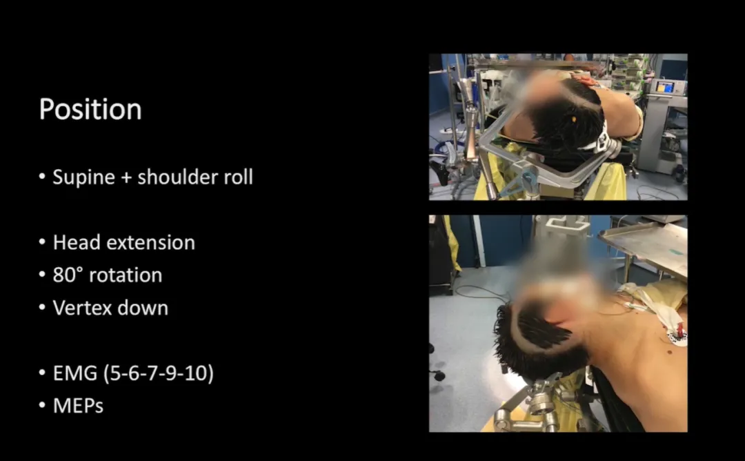 手术体位-位置：仰卧；头部延伸；旋转80°；顶点向下