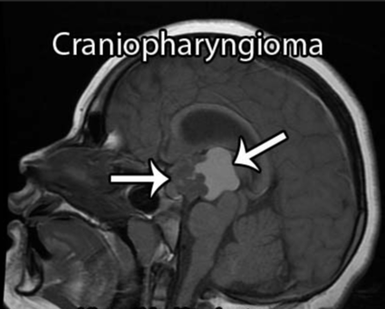 颅咽管瘤病变