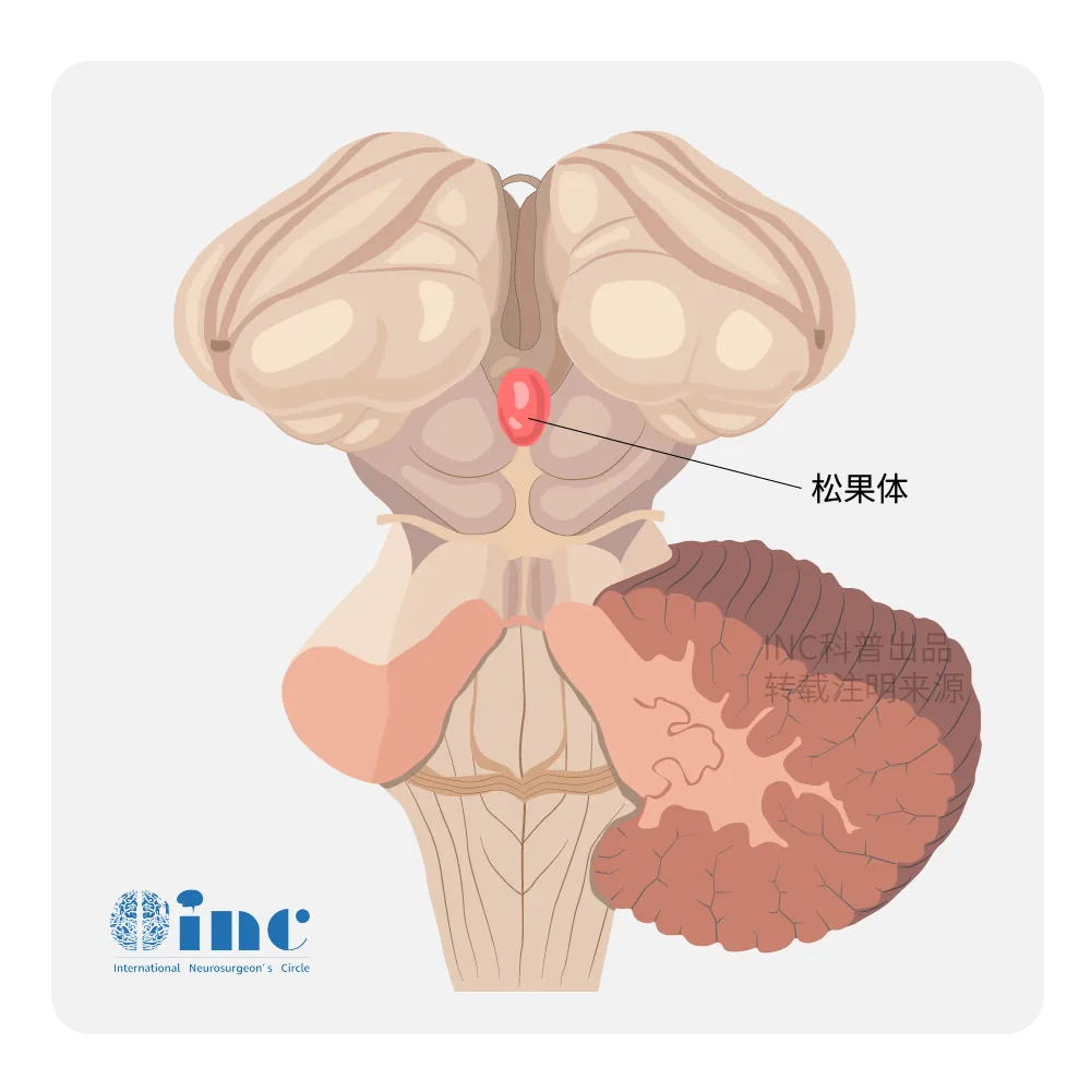 松果体位于大脑深部、第三脑室后方，是分泌褪黑素、调节睡眠-觉醒节律的神经内分泌器官。松果体区占位可压迫中脑导水管导致脑积水，或压迫四叠体出现Parinaud综合征（双眼上视困难），也可影响褪黑素分泌导致睡眠障碍。