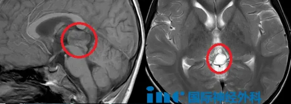 影像学上，松果体实质肿瘤具有特征性表现：CT可见钙化灶，MRI上边界清晰，增强后可见强化。与生殖细胞瘤不同，松果体实质肿瘤常导致正常松果体钙化向周边"爆炸式"推移。