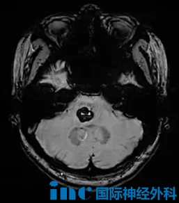 这一次不再被动等待，寻求巴教授主刀的示范手术。