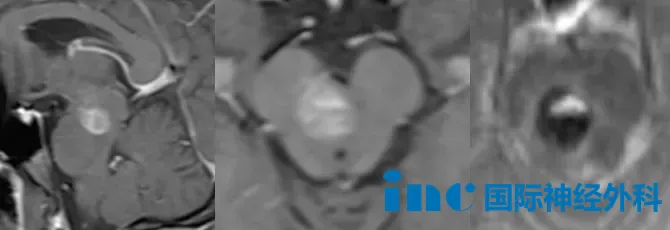 无法行走，言语更加含混，视力也变得模糊